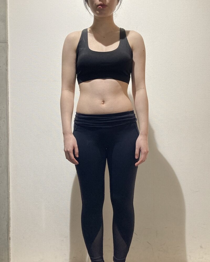 反り腰・下半身太りに悩んでいた20代女性 ビフォー