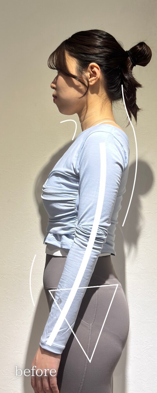 慢性的な肩こり・猫背に悩んでいた30代女性 ビフォー